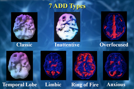 brain ADD 7 types