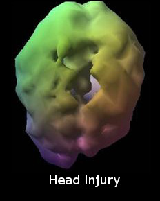 brain head injury